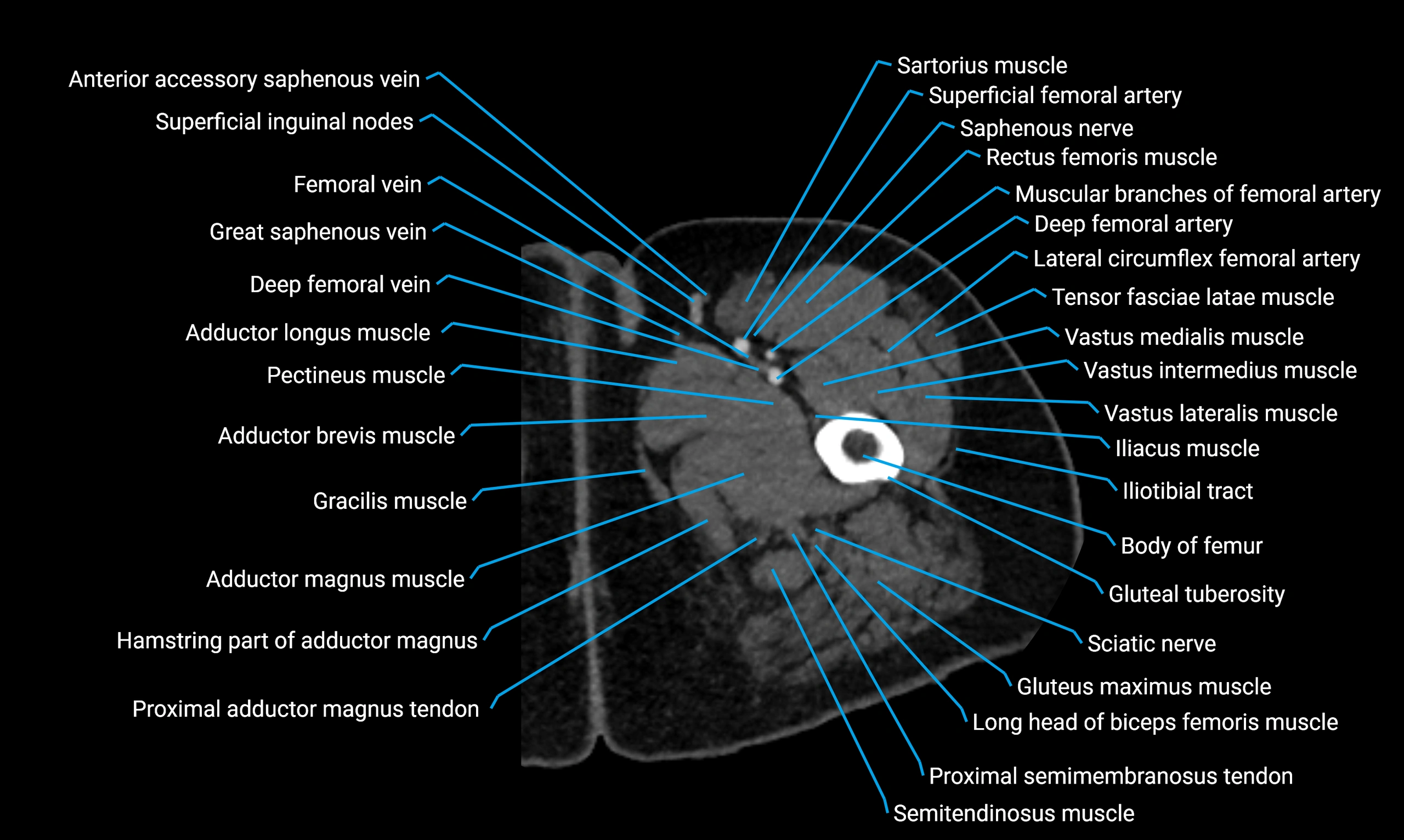 CT thigh axial cross sectional anatomy labelled image_22 (2).webp